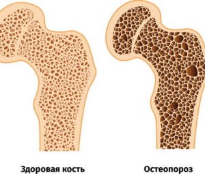 osteoporoz25012022